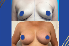 BA-G-Front-High-Profile-AP